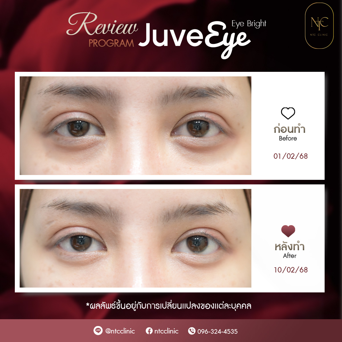 Eye_1