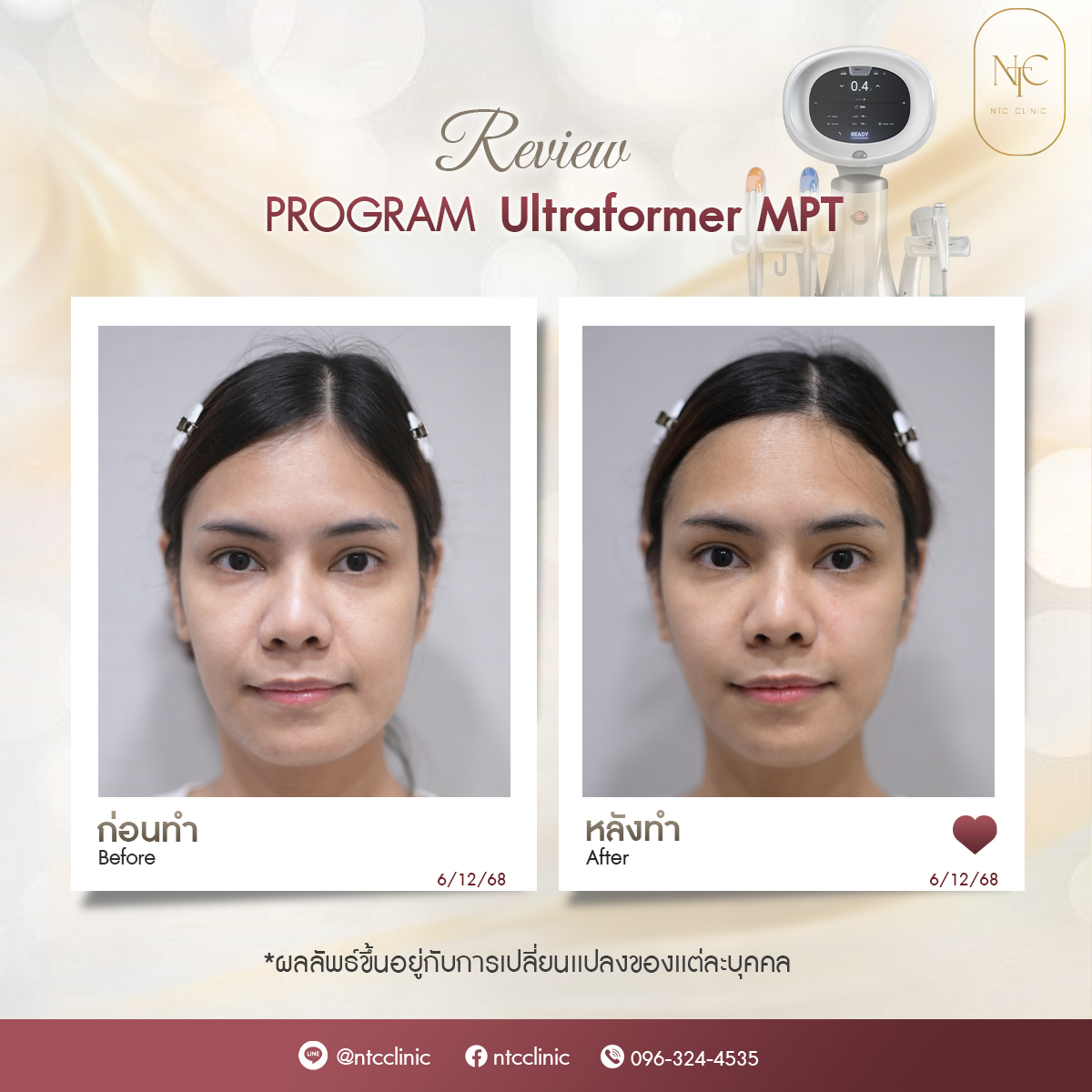 bf-at MPT_1