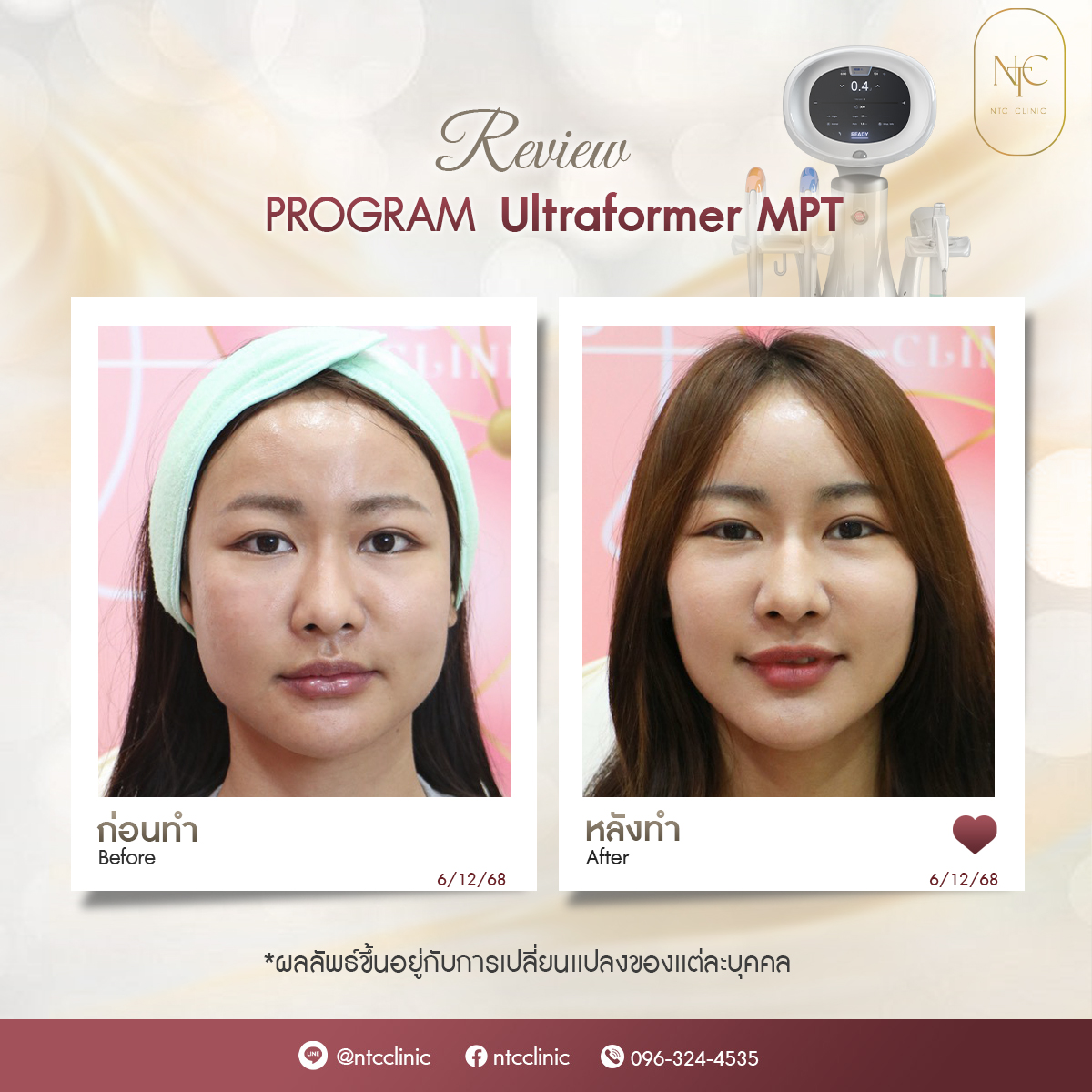 bf-at MPT_3