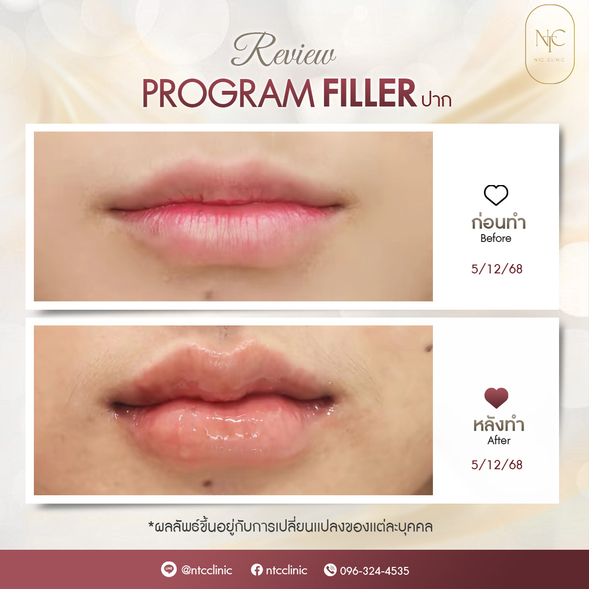 bf-at filler_ปาก