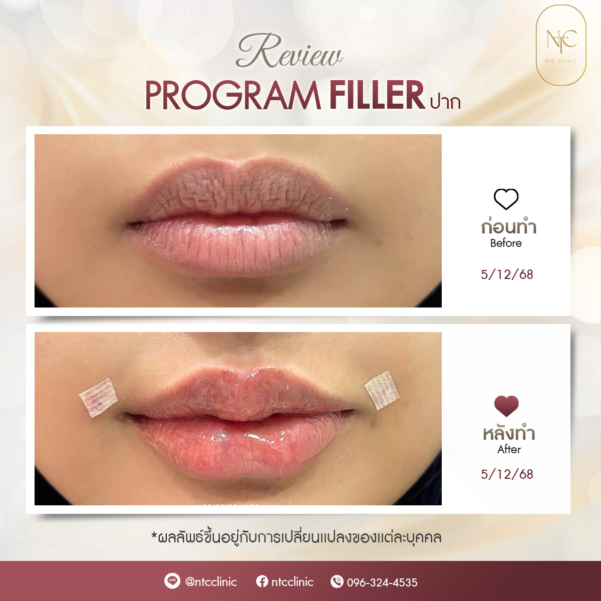 bf-at filler_ปาก_2